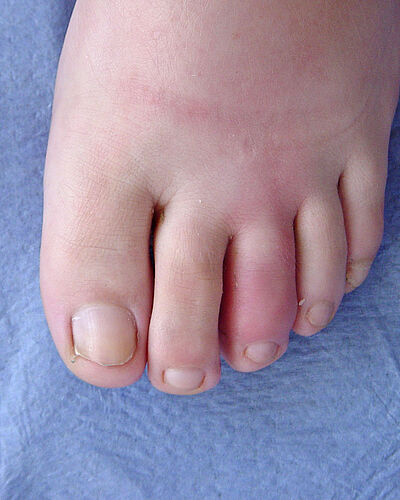 30 ans de suivi des arthrites réactionnelles