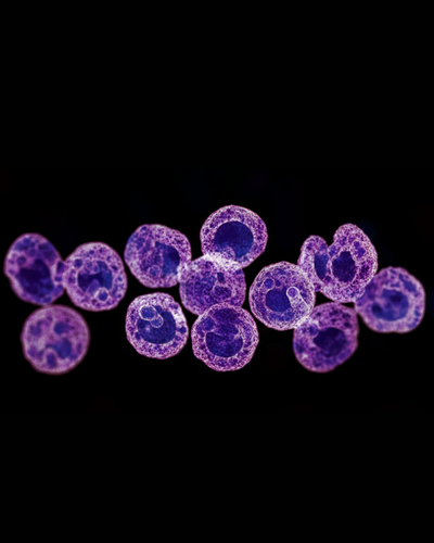 Diagnostic intégratif des leucémies à cellule dendritiques blastiques plasmocytoïdes et autres hémopathies impliquant des pDC : le réseau ROMI est reconduit en tant que laboratoire de biologie médicale de référence