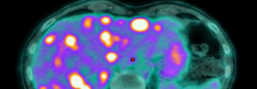 Une avancée majeure dans le traitement du cancer anal grâce à une stratégie combinant immunothérapie et radiothérapie adaptative
