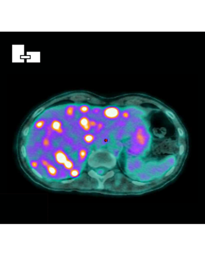 Une avancée majeure dans le traitement du cancer anal grâce à une stratégie combinant immunothérapie et radiothérapie adaptative